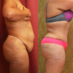 Tummy Tuck (Abdominoplasty) Plus Size Before & After Patient #11797