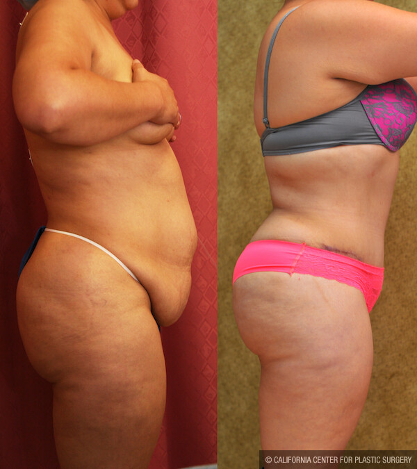 Tummy Tuck (Abdominoplasty) Plus Size Before & After Patient #11797