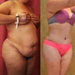 Tummy Tuck (Abdominoplasty) Plus Size Before & After Patient #11797