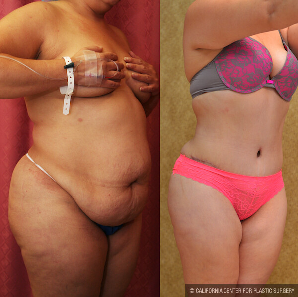 Tummy Tuck (Abdominoplasty) Plus Size Before & After Patient #11797