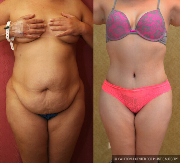 Tummy Tuck (Abdominoplasty) Plus Size Before & After Patient #11797