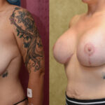 Breast Lift - Full Before & After Patient #11809