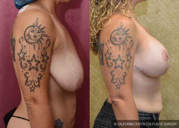 Breast Lift - Full Before & After Patient #11809