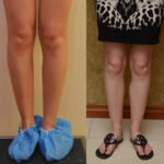 Calf Augmentation Before & After Patient #11827