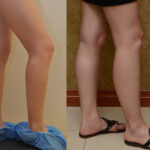 Calf Augmentation Before & After Patient #11827