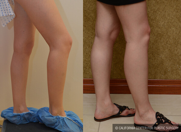 Calf Augmentation Before & After Patient #11827