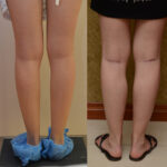 Calf Augmentation Before & After Patient #11827