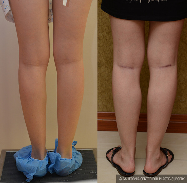 Calf Augmentation Before & After Patient #11827
