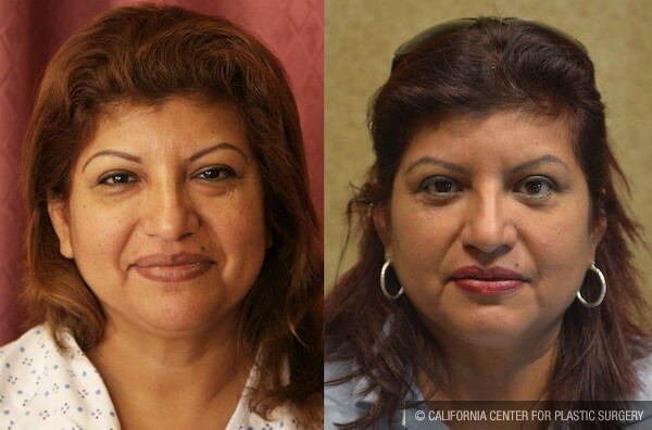 Eyelid (Blepharoplasty) Before & After Patient #11831