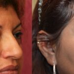 Eyelid (Blepharoplasty) Before & After Patient #11831