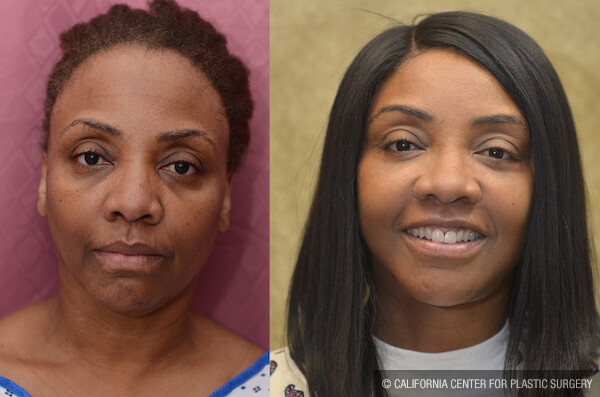 Facelift Before & After Patient #11836