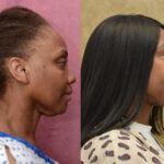 Facelift Before & After Patient #11836