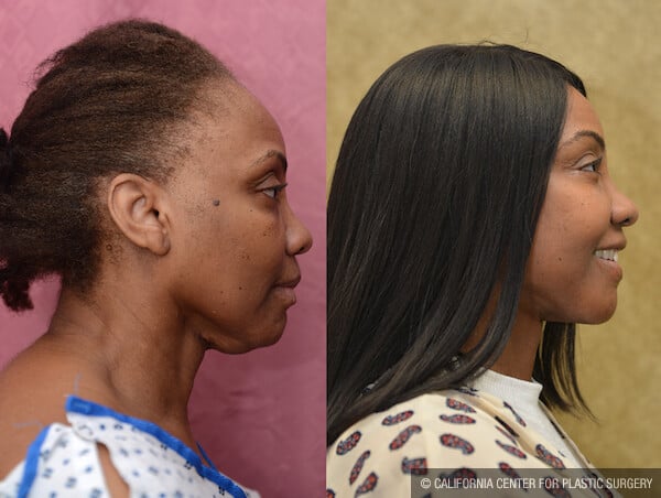 Facelift Before & After Patient #11836