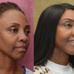 Facelift Before & After Patient #11836
