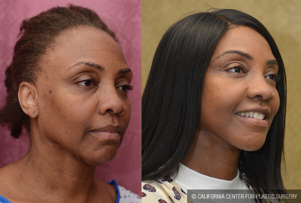 Facelift Before & After Patient #11836