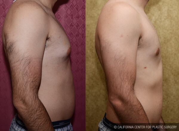 Male gynecomastia (breast) reduction Before & After Patient #11841