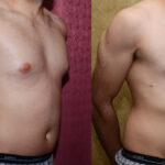 Male gynecomastia (breast) reduction Before & After Patient #11841