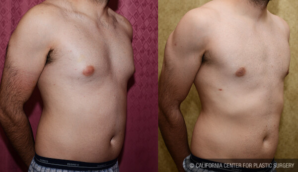Male gynecomastia (breast) reduction Before & After Patient #11841