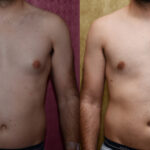 Male gynecomastia (breast) reduction Before & After Patient #11841