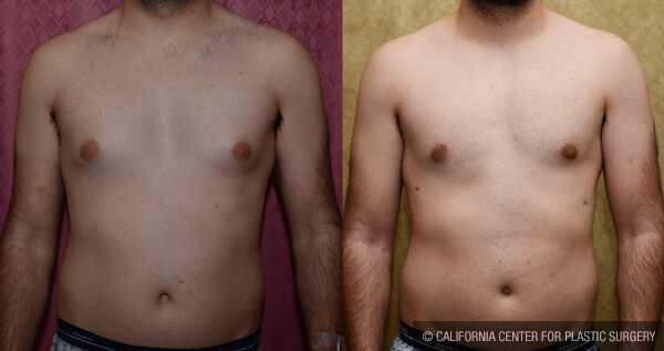 Male gynecomastia (breast) reduction Before & After Patient #11841