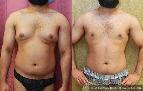 Male gynecomastia (breast) reduction Before & After Patient #11916