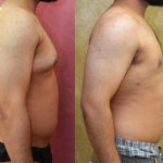 Male gynecomastia (breast) reduction Before & After Patient #11916