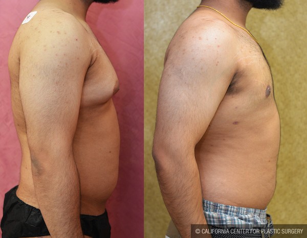 Male gynecomastia (breast) reduction Before & After Patient #11916