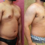 Male gynecomastia (breast) reduction Before & After Patient #11916