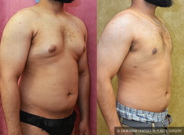 Male gynecomastia (breast) reduction Before & After Patient #11916