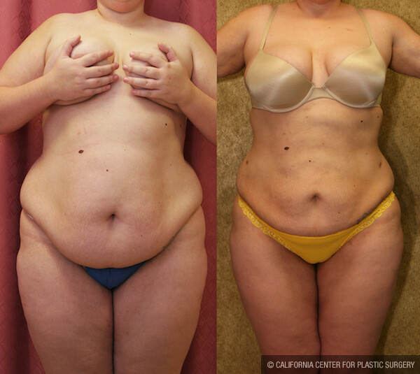 Liposuction Abdomen Plus Size Before & After Patient #11861