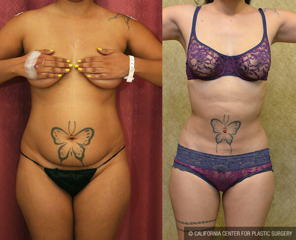 Liposuction Abdomen Medium Before & After Patient #11853