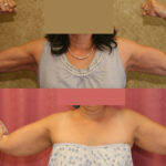 Liposuction Arms Before & After Patient #11865