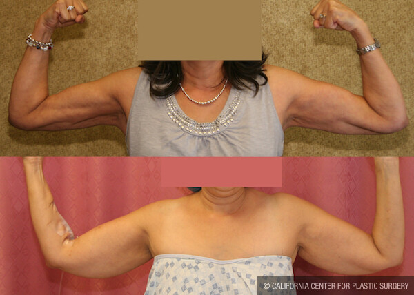 Liposuction Arms Before & After Patient #11865