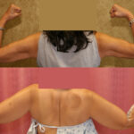 Liposuction Arms Before & After Patient #11865