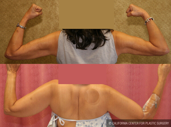 Liposuction Arms Before & After Patient #11865