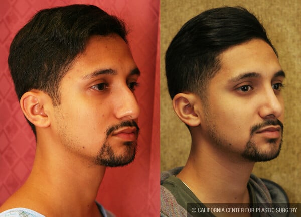 Male Rhinoplasty Before & After Patient #11875