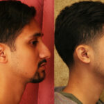 Male Rhinoplasty Before & After Patient #11875