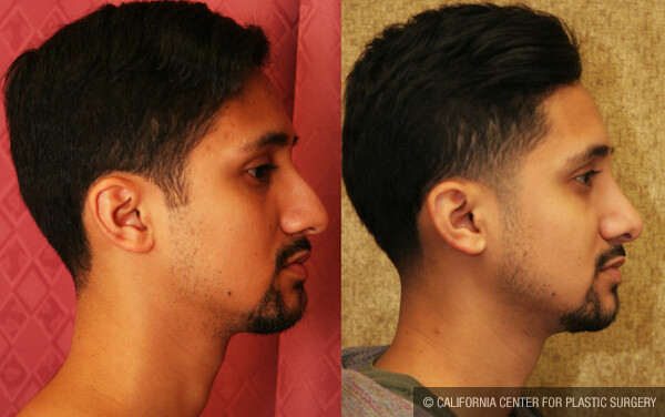 Male Rhinoplasty Before & After Patient #11875