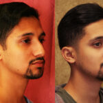 Male Rhinoplasty Before & After Patient #11875