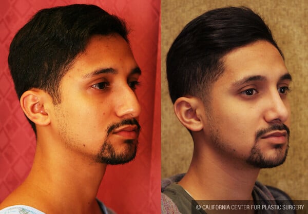 Male Rhinoplasty Before & After Patient #11875