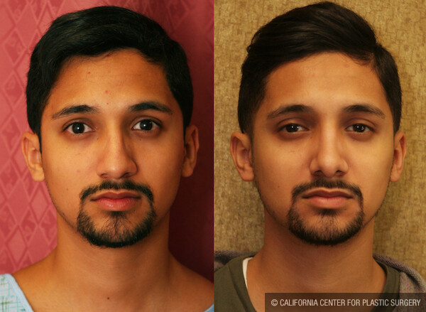 Male Rhinoplasty Before & After Patient #11875