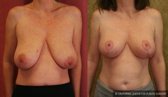 Full Breast Lift Before & After Patient #11948