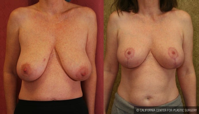 Breast Lift - Full Before & After Patient #11948