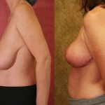 Breast Lift - Full Before & After Patient #11948
