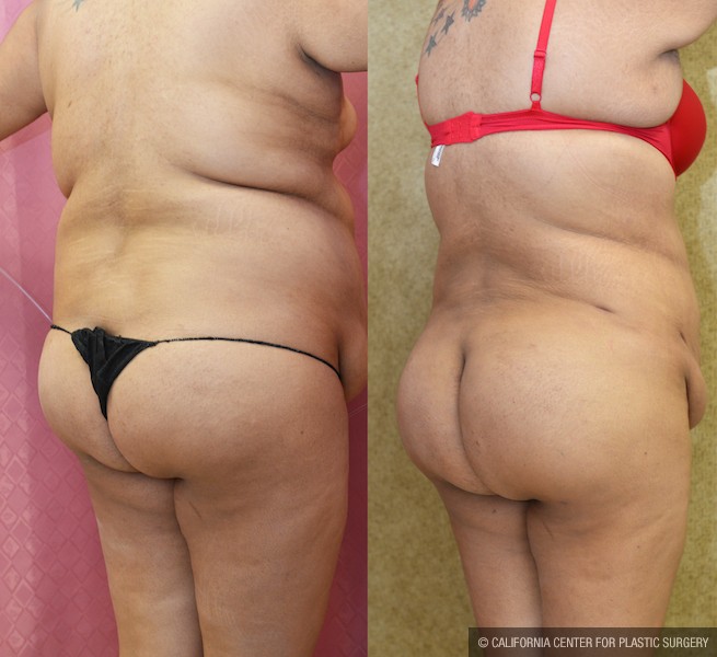 Buttock Lift/Augmentation Before & After Patient #11959