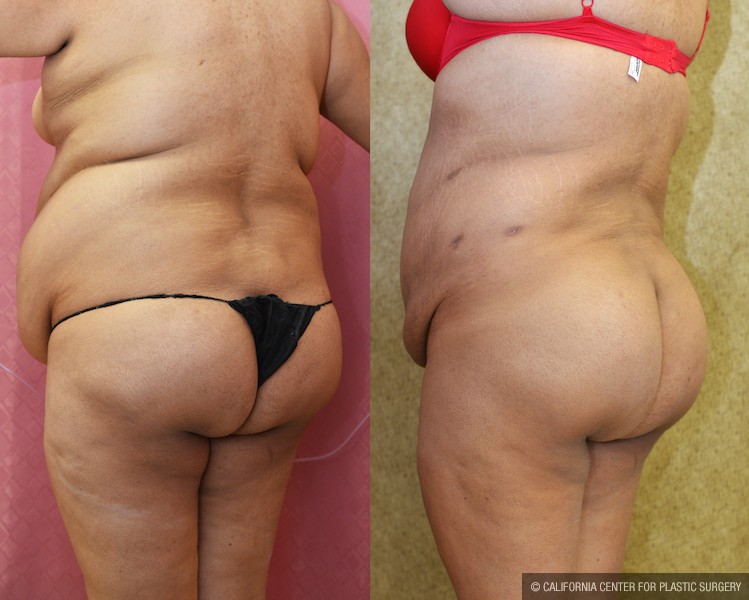 Buttock Lift/Augmentation Before & After Patient #11959