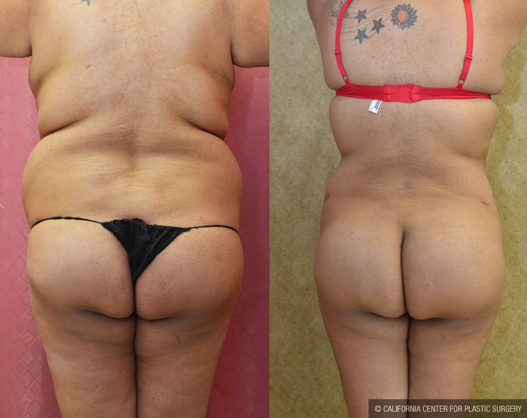 Buttock Lift/Augmentation Before & After Patient #11959