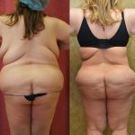 Buttock Lift/Augmentation Before & After Patient #11964
