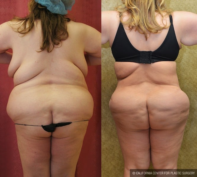 Buttock Lift/Augmentation Before & After Patient #11964