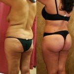 Buttock Lift/Augmentation Before & After Patient #11966